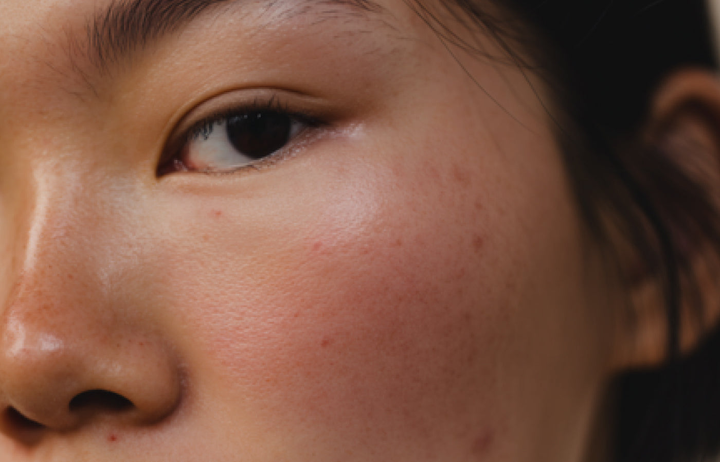 Post-summer skin: How to reduce blemishes and regulate sebum production